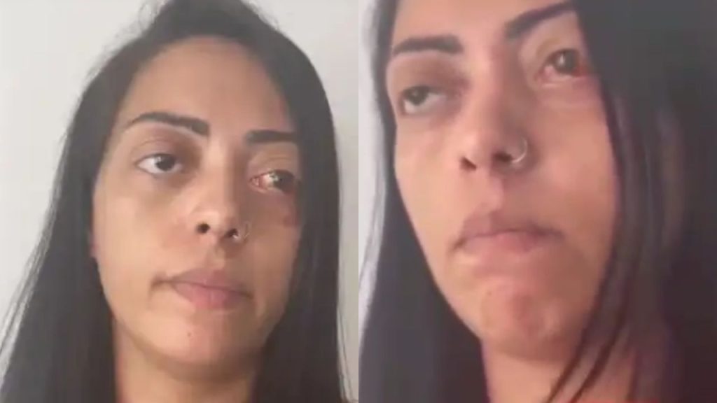 'Ele está solto, eu estou presa', diz mulher que quase perdeu o olho após ataque do ex-companheiro