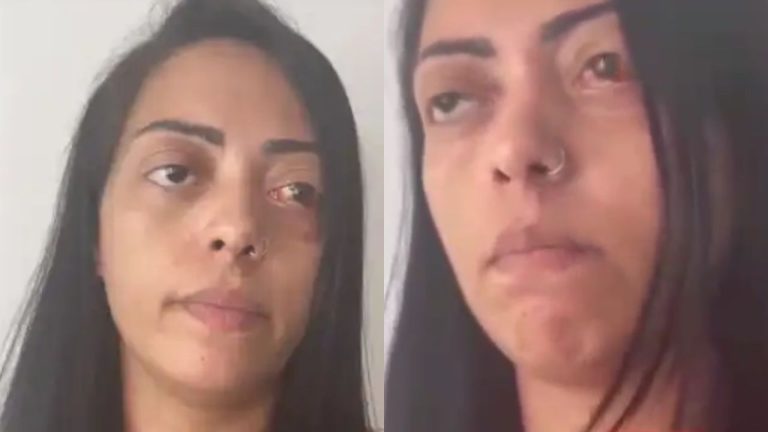 'Ele está solto, eu estou presa', diz mulher que quase perdeu o olho após ataque do ex-companheiro